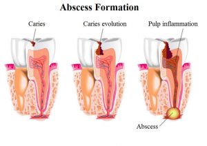 abscess formation and treatment