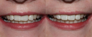 Repairing Chipped Front Teeth with teeth bonding